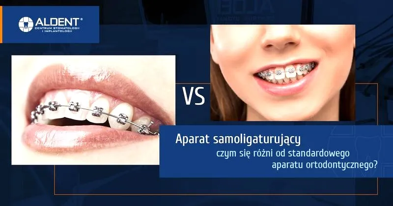 Jak skutecznie wykorzystać aparat samoligaturujący w ortodoncji?