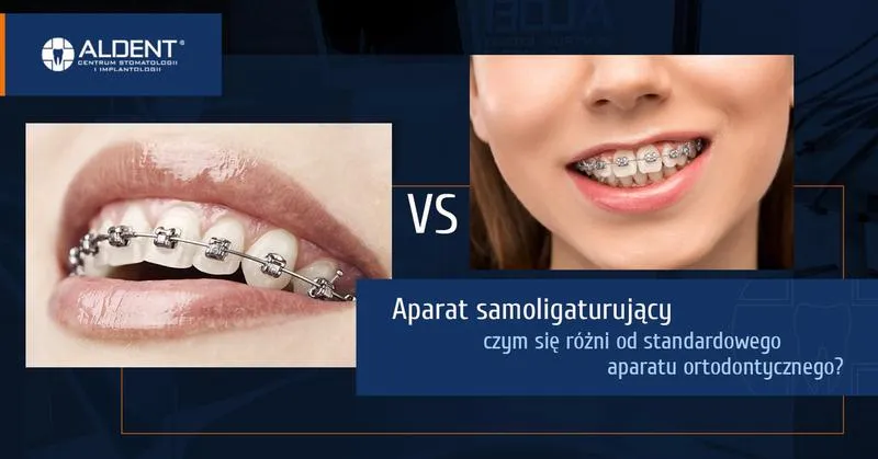 Korzyści i wady aparatów samoligaturujących
